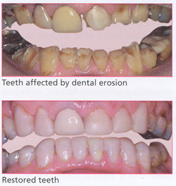 Dental Erosion