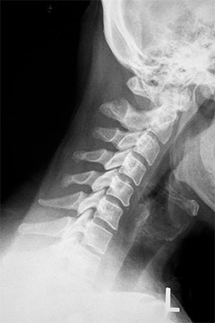 Neck Xray